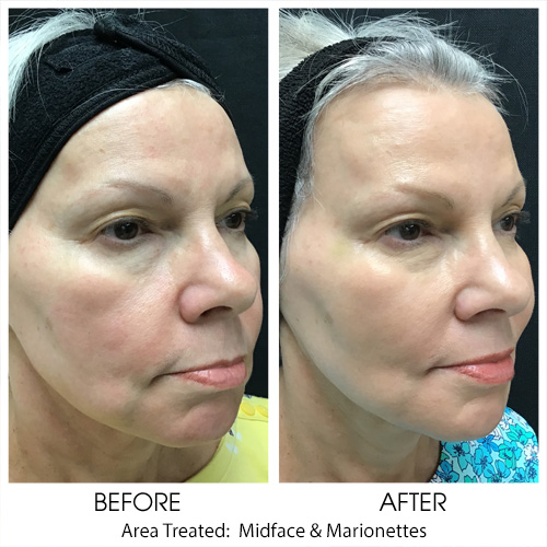 Before + After Gallery: Face