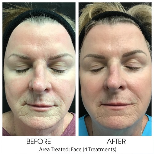 Before + After Gallery: Face
